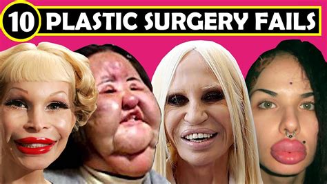biggest plastic surgery fails